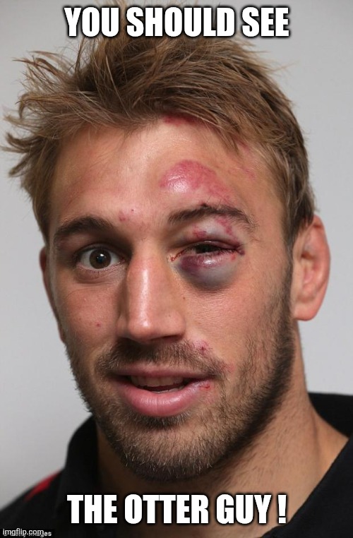 You should see The otter guy ! | image tagged in black eye | made w/ Imgflip meme maker