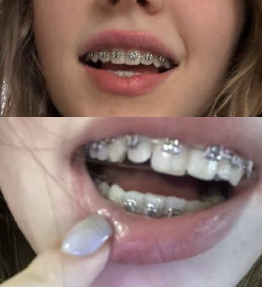 #braces Blank Meme Template