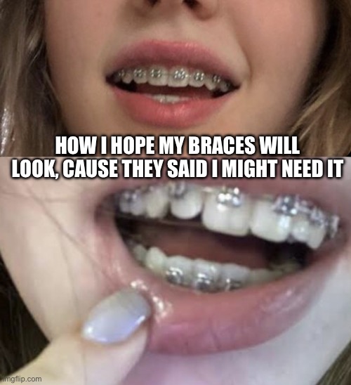 #braces | How I hope my braces will look, cause they said I might need it | image tagged in braces | made w/ Imgflip meme maker