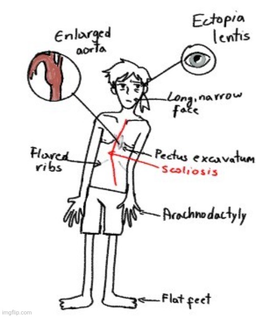 Marfan syndrome | image tagged in dea,drawing | made w/ Imgflip meme maker