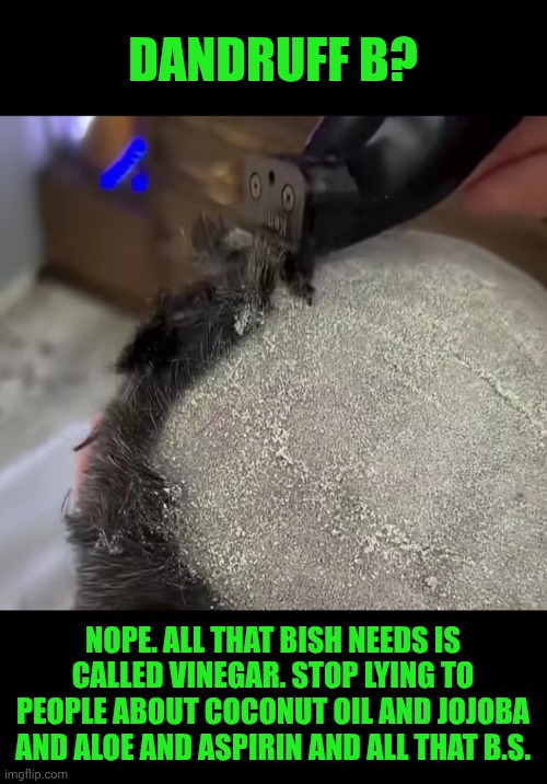 Funny | Dandruff b? Nope. All that bish needs is called vinegar. Stop lying to people about coconut oil and jojoba and aloe and aspirin and all that b.s. | image tagged in funny,hair,skin,dry,ash,cure | made w/ Imgflip meme maker