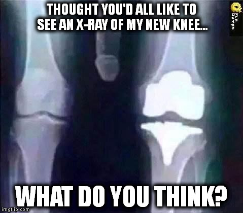 THOUGHT YOU'D ALL LIKE TO SEE AN X-RAY OF MY NEW KNEE... WHAT DO YOU THINK? | image tagged in new knee | made w/ Imgflip meme maker