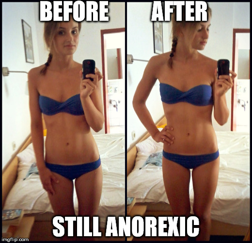 BEFORE          AFTER STILL ANOREXIC | image tagged in skinny | made w/ Imgflip meme maker