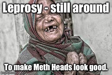 Leprosy - I'm not half the man I used to be . . . | Leprosy - still around; To make Meth Heads look good. | image tagged in leper,leprosy,meth head,yeaterday,beatles | made w/ Imgflip meme maker